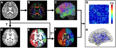 Flattened Structural Network Changes and Association of Hyperconnectivity With Symptom Severity in 2–7-Year-Old Children With Autism